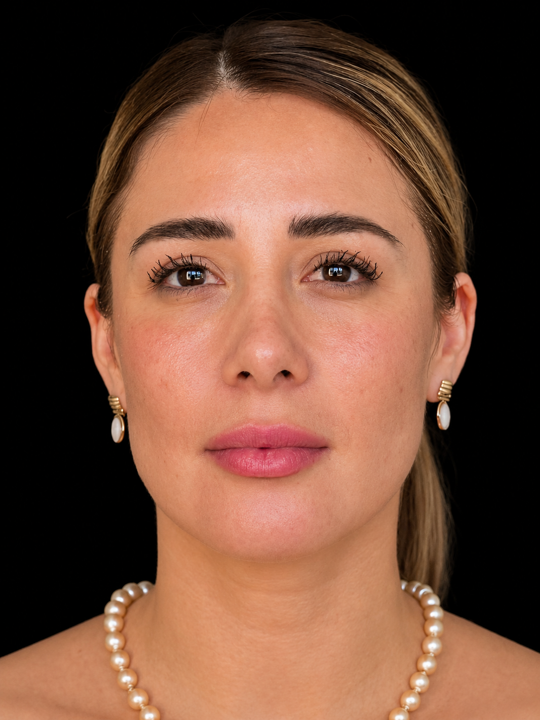 Antes de Hilos Tensores – Dra. Diana Barrera