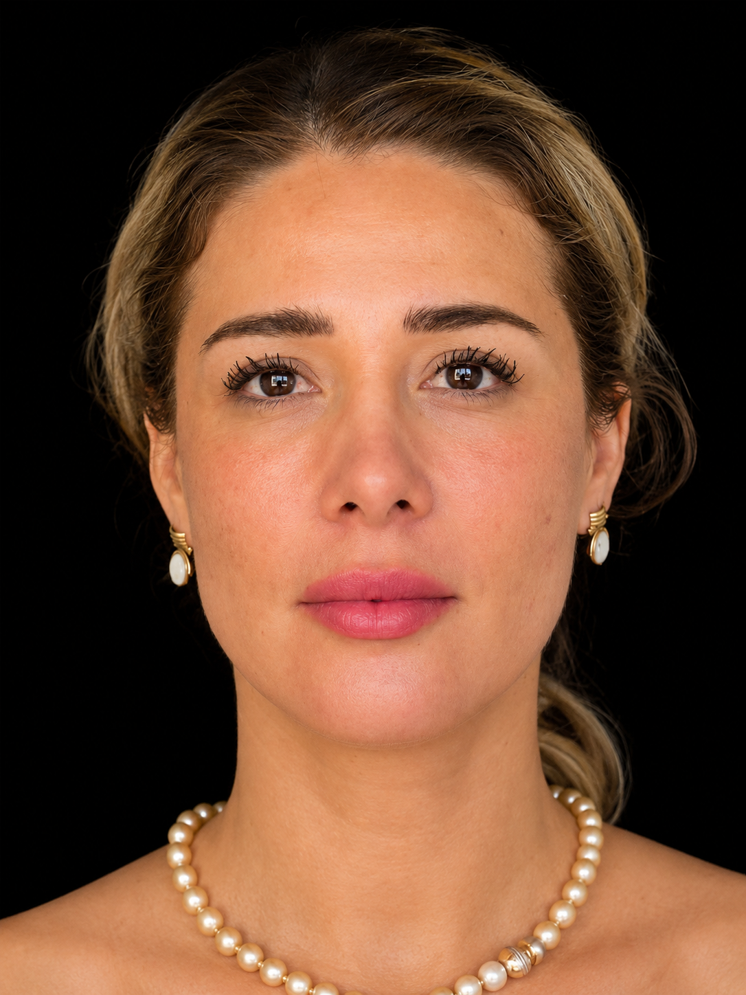 Después de Hilos Tensores – Dra. Diana Barrera