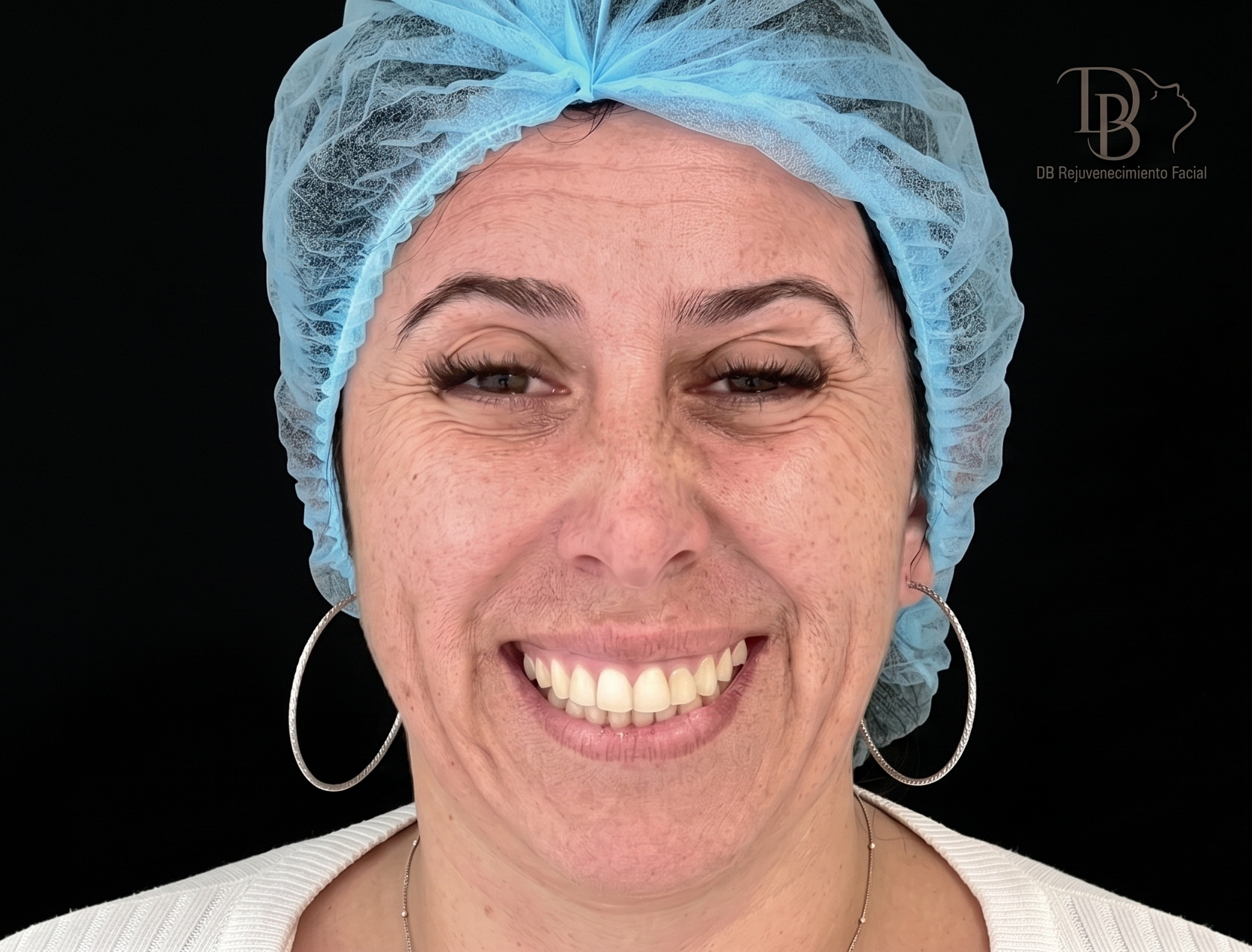 Antes Full Face – Dra. Diana Barrera