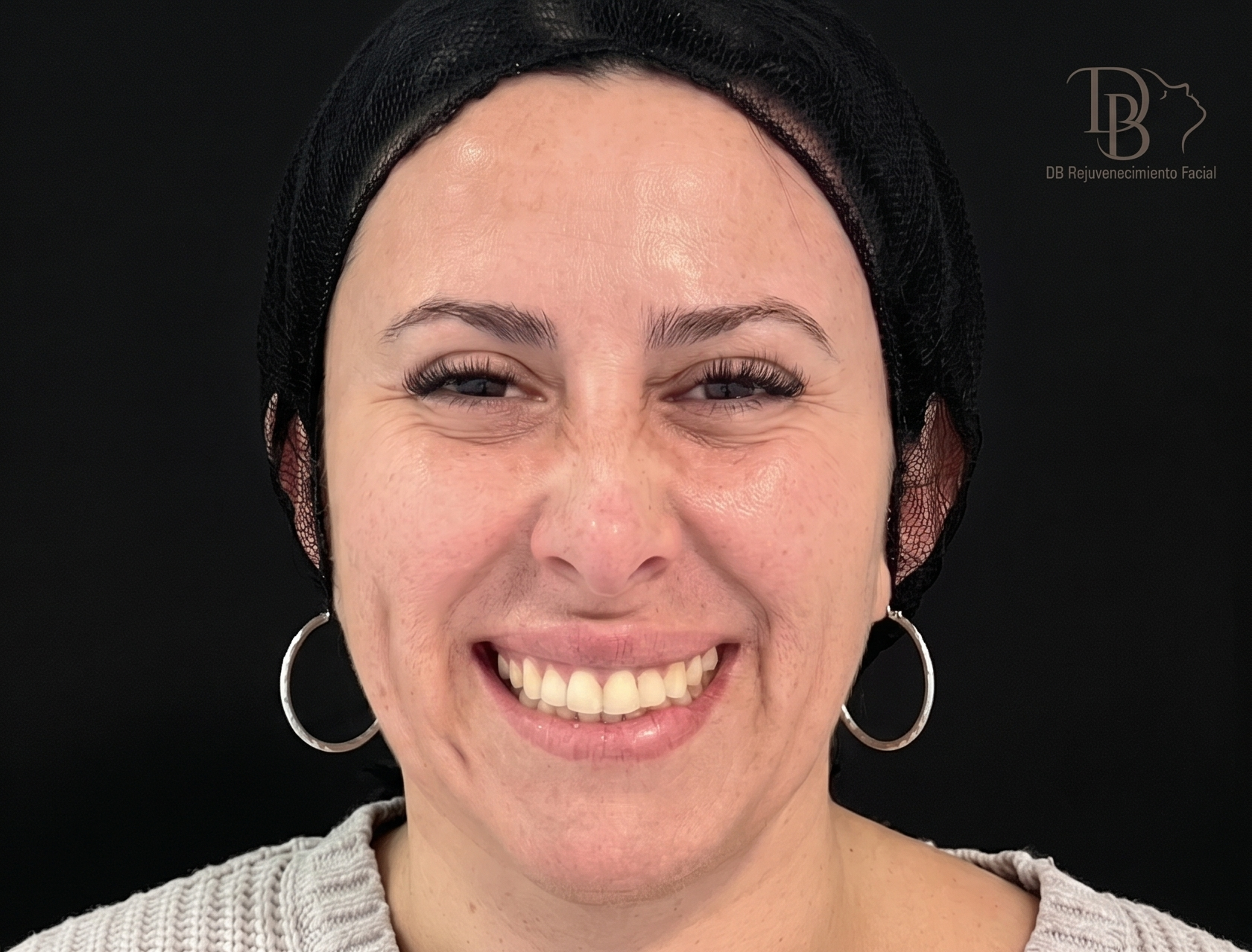 Después Full Face – Dra. Diana Barrera