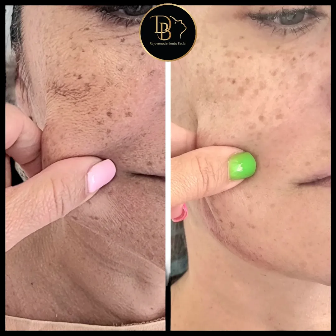 Antes y después de bioestimulación de colágeno en paciente de la Dra. Diana Barrera