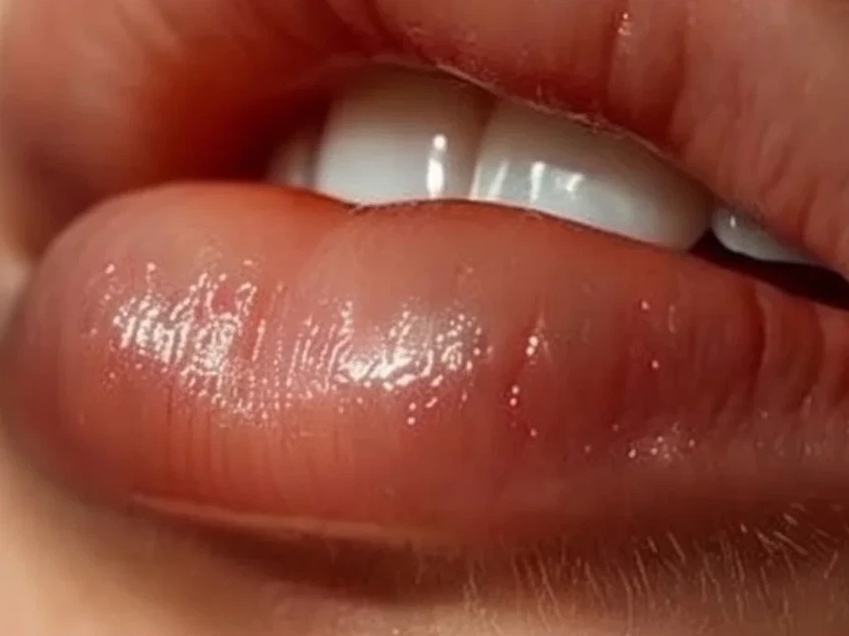 Perfiloplastía con ácido hialurónico — labios voluminosos naturales