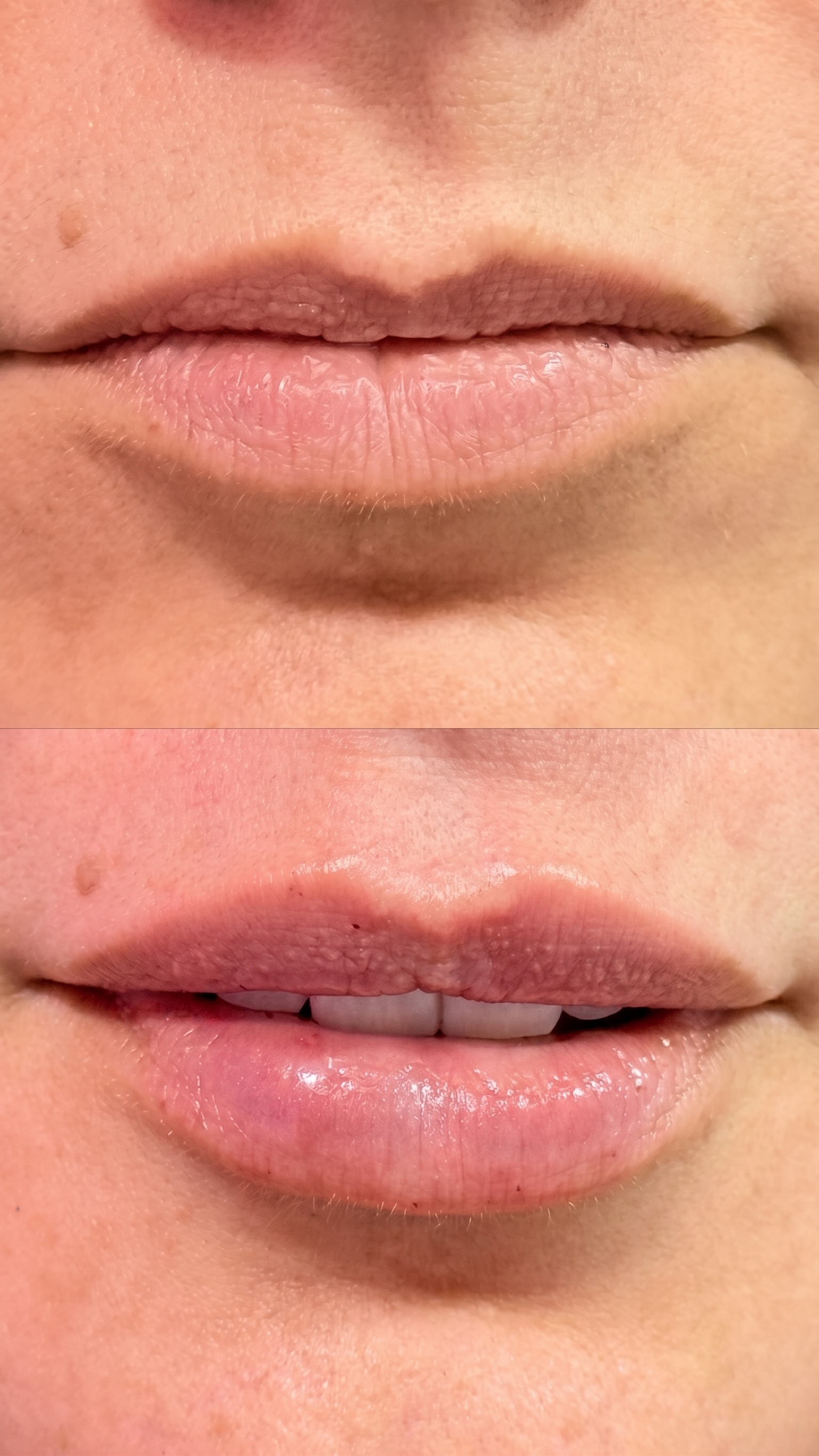 Antes y después de hidratación y aumento de labios – Dra. Diana Barrera
